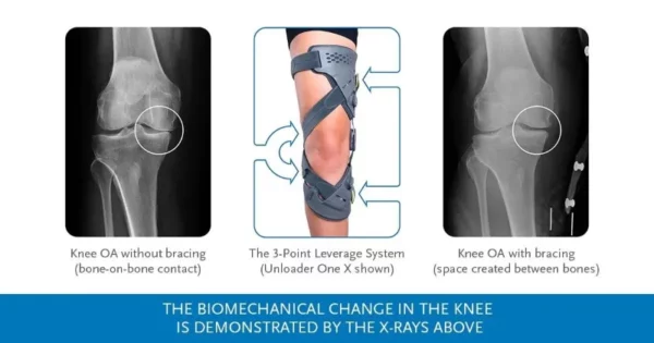knee bracing