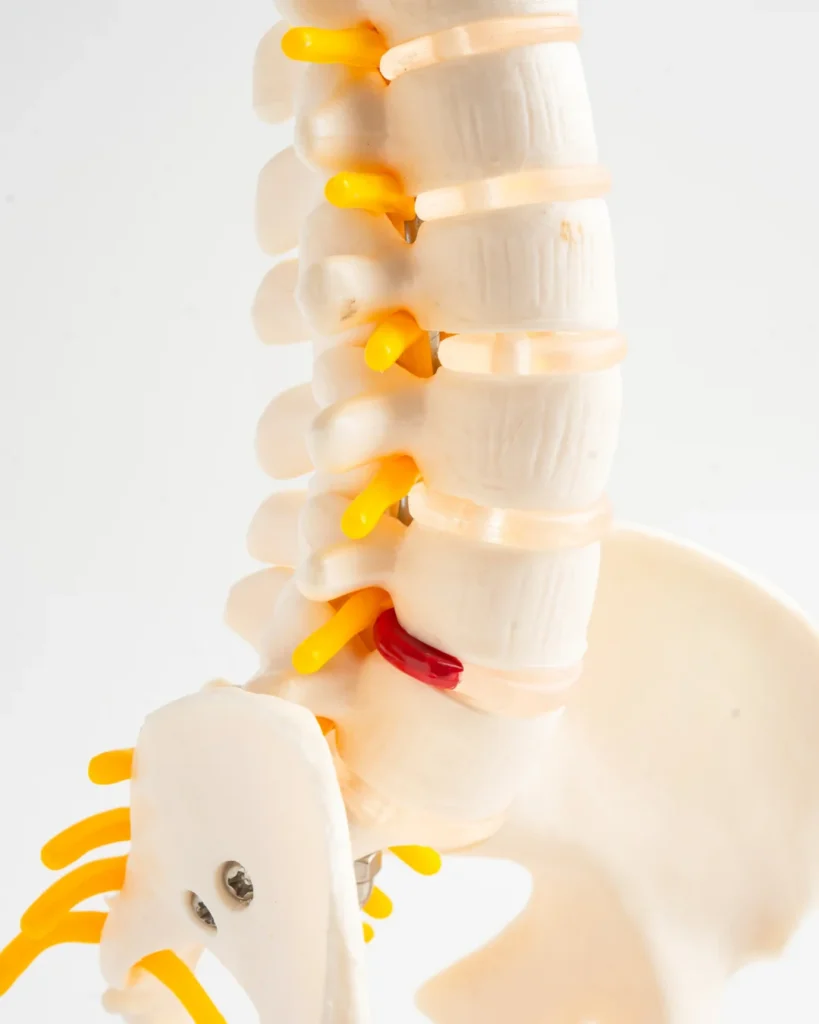Sciatica 1