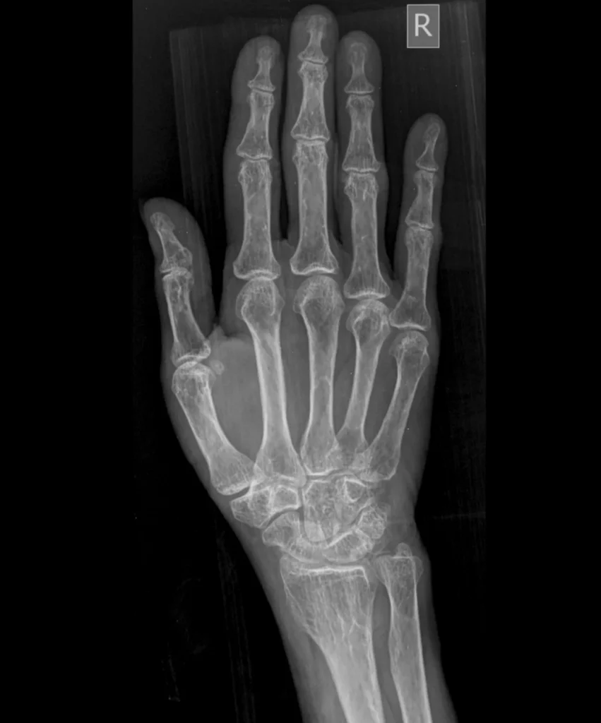 Trigger finger or Trigger Thumb e1780278323247