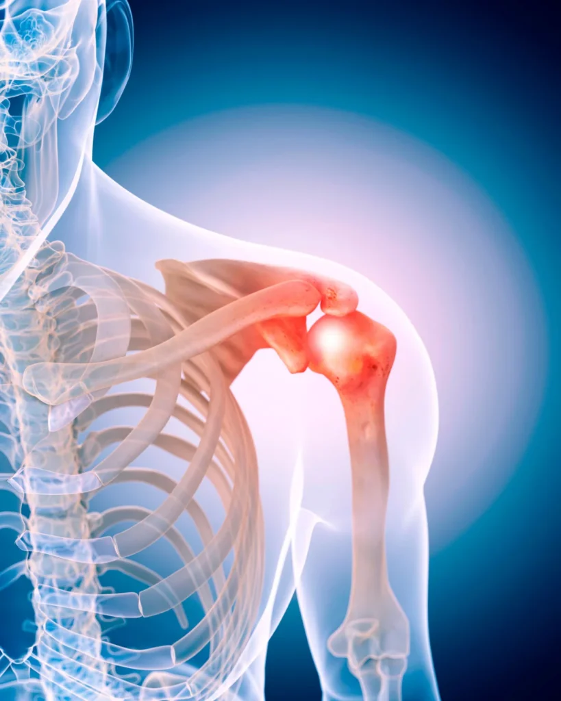 osteoarthritis